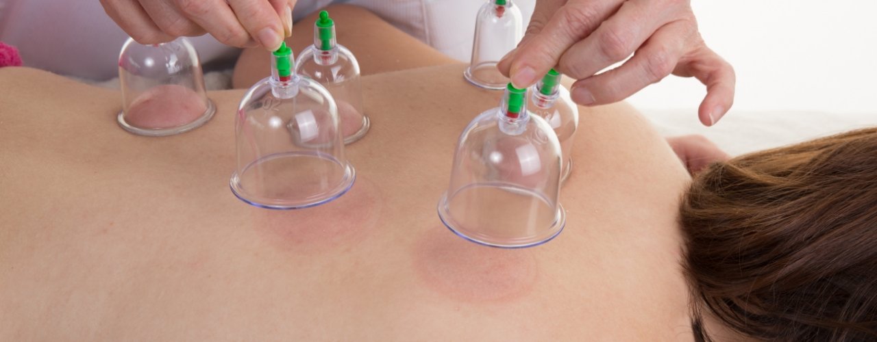 physical-therapy-clinic-cupping-UNIQ-physical-therapy-warminster-pa