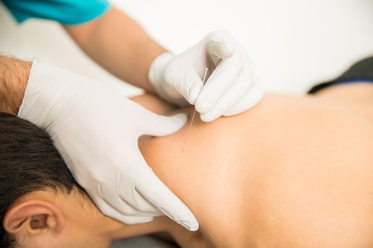 dry-needling-therapy - UPT
